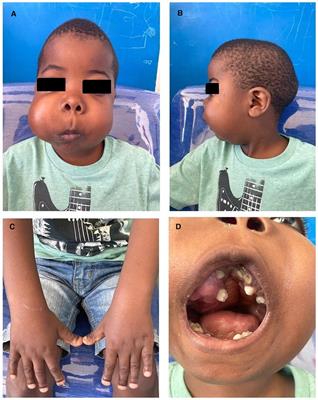 Case report: a giant cell-rich gnathic bone lesion in a child with pycnodysostosis